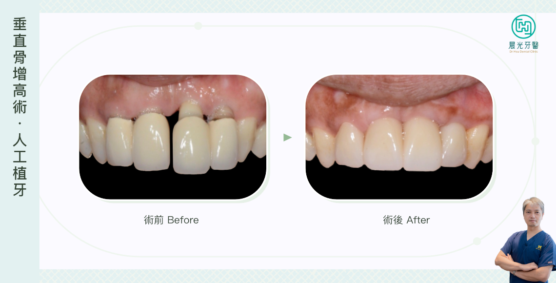 重建前牙區，外觀與功能兼顧！